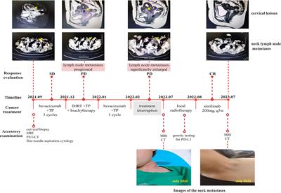 Case report: Giant lymph node metastases: a new opportunity for cancer radioimmunotherapy?